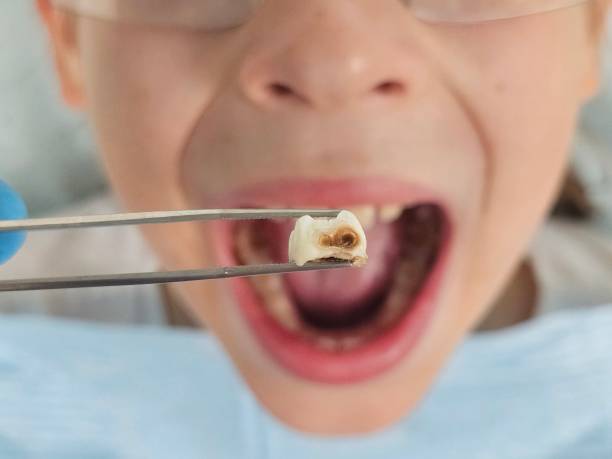 Best Same-Day Emergency Dental Services in Centreville, MD
